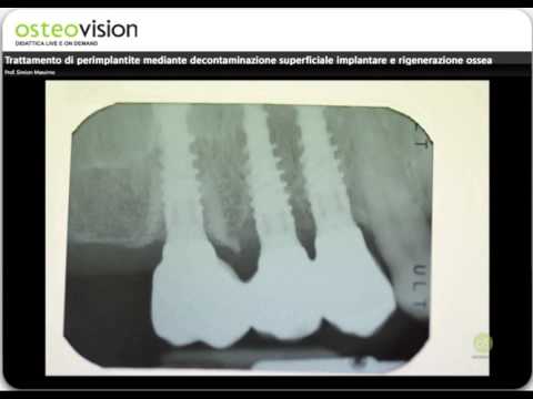 Video: 11β-HSD1 Svolge Un Ruolo Critico Nella Perdita Ossea Trabecolare Associata Alla Terapia Sistemica Con Glucocorticoidi