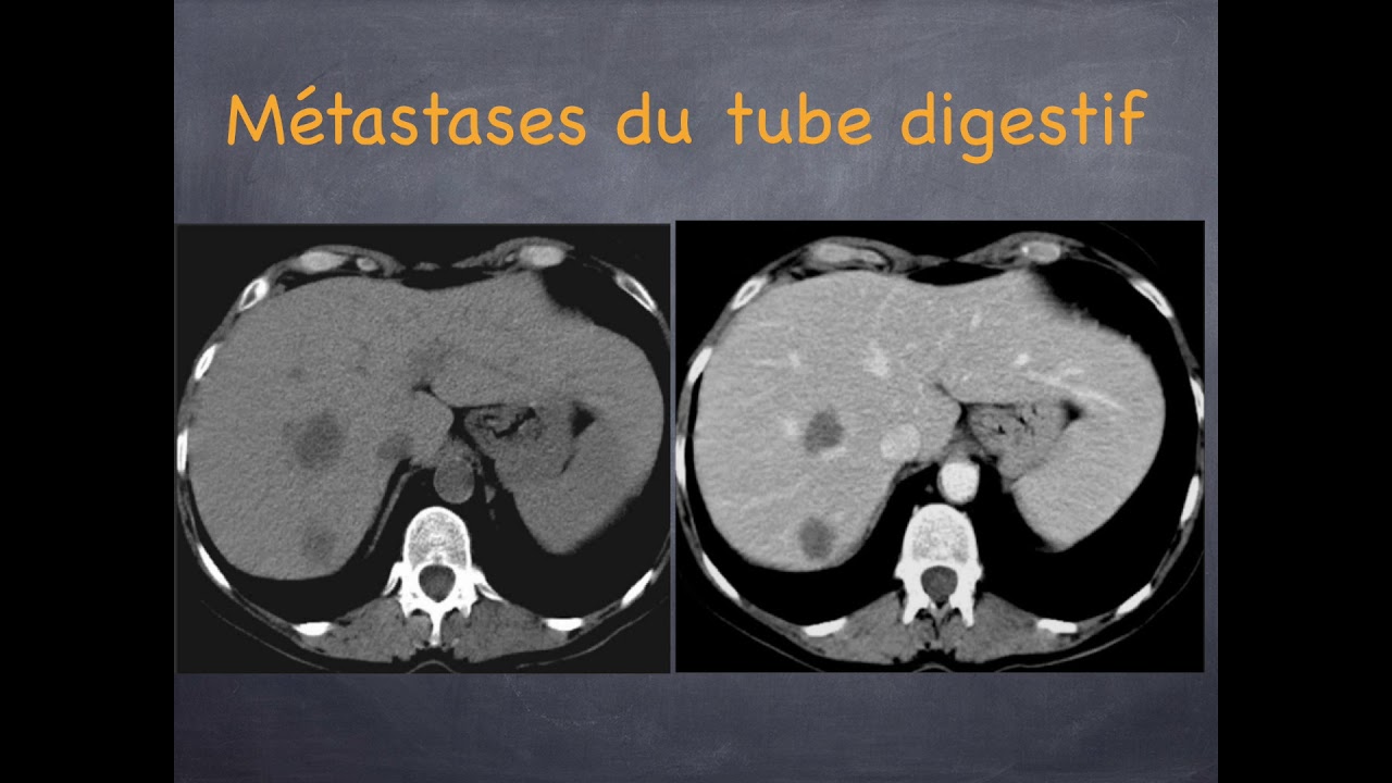 Tumeurs du foie - Malignes - 4. Métastases hépatiques