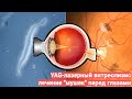 YAG лазерный витреолизис - метод лечение мушек перед глазами 💥🪰👀 или ДСТ