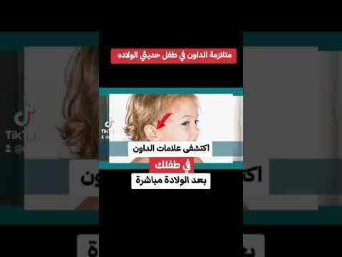 دخالدكمال استشارى طب الاطفال وحديثي الولادة للحجزبالعيادة٠١١٤٣٣١١١٩٩ متلازمة داون