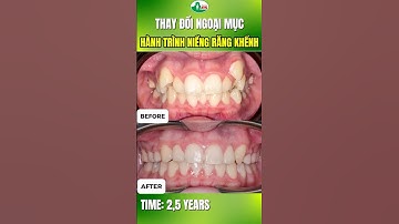 Hành Trình Từ Răng Khểnh Đến Nụ cười Đều Đẹp I NHA KHOA AN TÂM SÀI GÒN