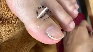 HOW TO CUT THICK TOENAILS - Toenail Cleaning Satisfying #833