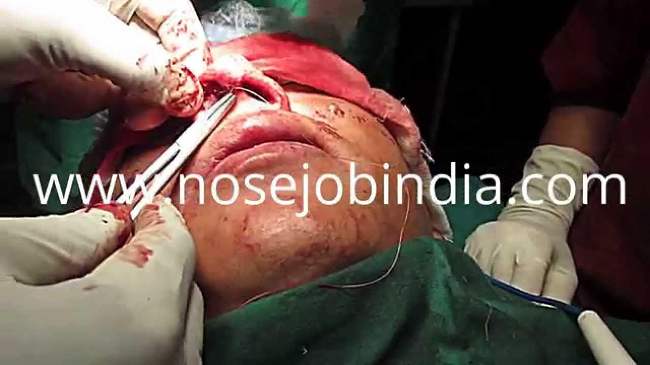 surgery cost how much does nose surgery cost surgery cost how much does nose surgery cost