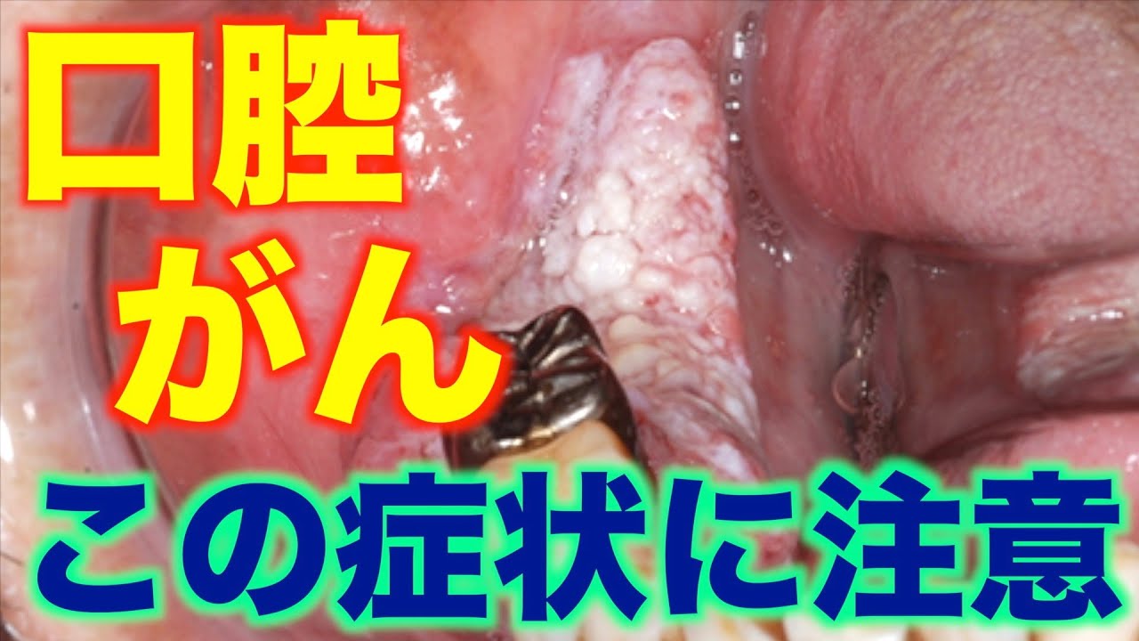 歯肉 癌 初期 画像
