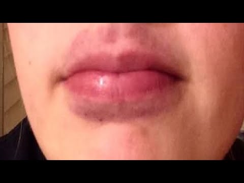 bruising on.lip from c pap Spontaneous on the lip - Stock Image - C004/2484 Crazy bruising ?! : r/PlasticSurgery