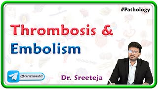 13. Thrombosis And Embolism | USMLE Step 1 Pathology