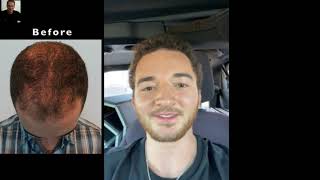 Fort Lauderdale Hair Transplant | Male Hair Loss Hair Transplant Results 1 Year