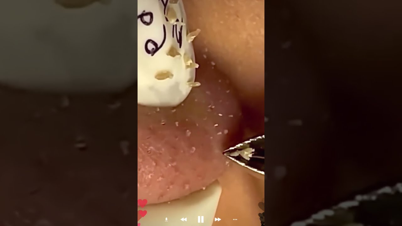 Skincare | Blackheads Removal 