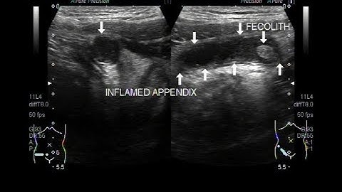 Ultrasound Video showing an inflamed appendix with fecolith.