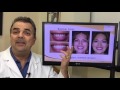 Porcelain Veneers Alternative - Bioclear vs bonding - San Diego Cosmetic Dentist