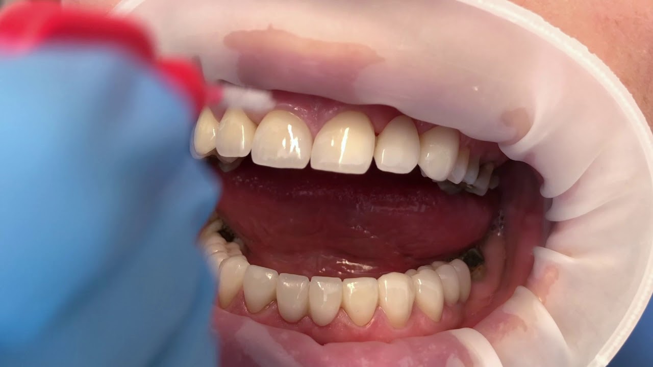 Jak čistit keramické korunky - JS Lab