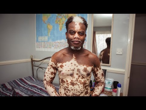 Video: Forskellen Mellem Albinisme Og Vitiligo