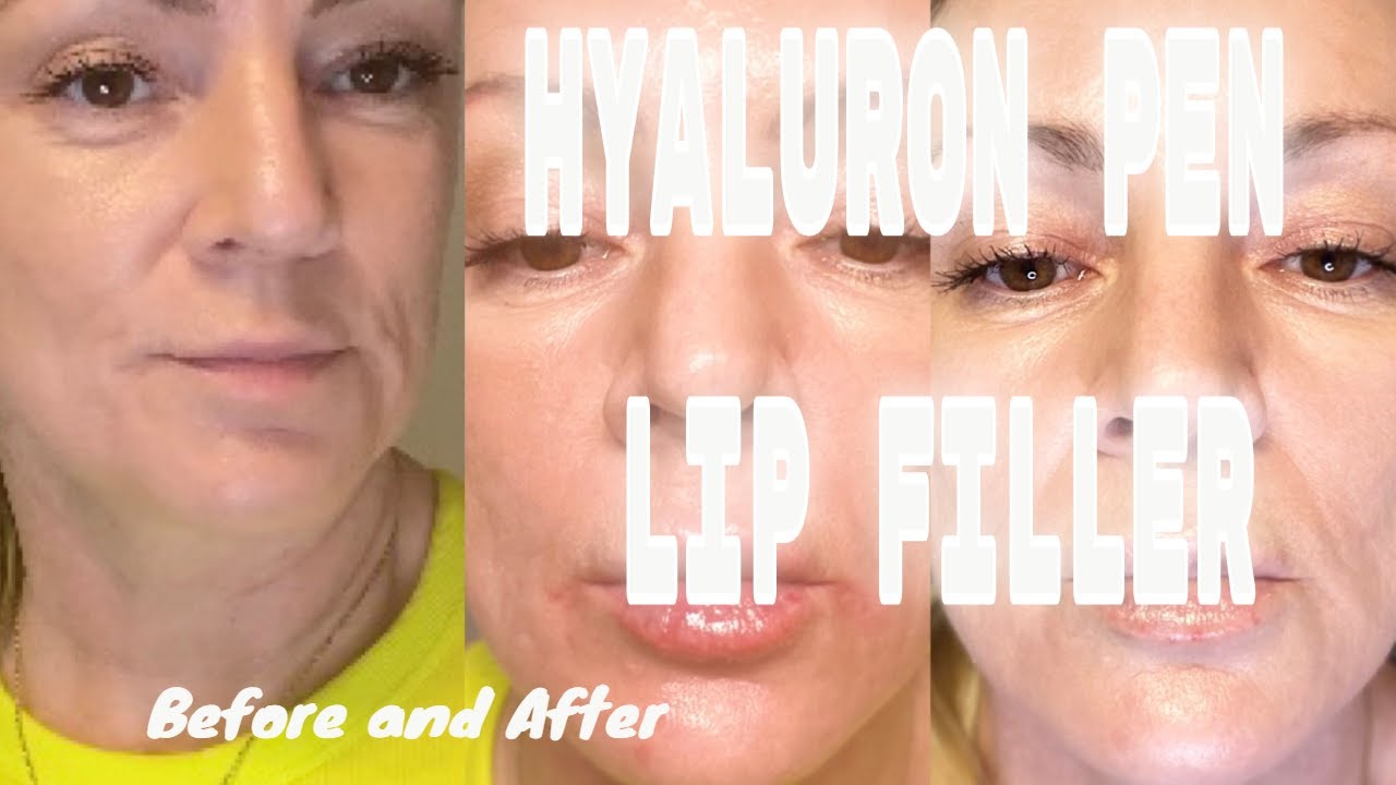 NO NEEDLE FILLER Hyaluron Pen for Lips Before and After YouTube