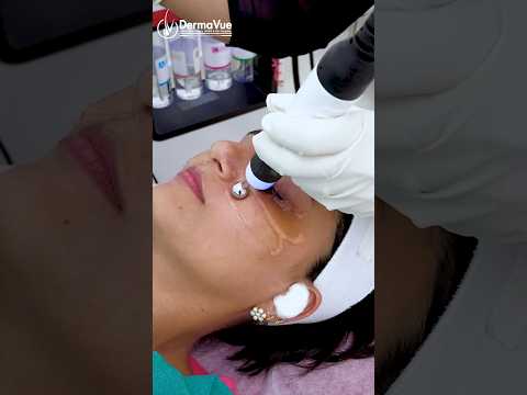 HydraFacial Benefits