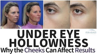 How Results of Under Eye Hollow Treatments can be Affected by Cheek Volume