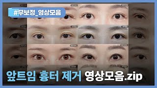 앞트임 흉터 제거하는 방법은? 축돌리기(앞트임복원+윗트임)