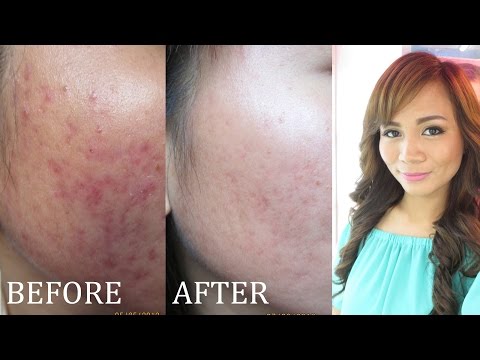 ACNE SCARS Treatment : Flawless Easy Peel Review (TagLish Video + Before and After)