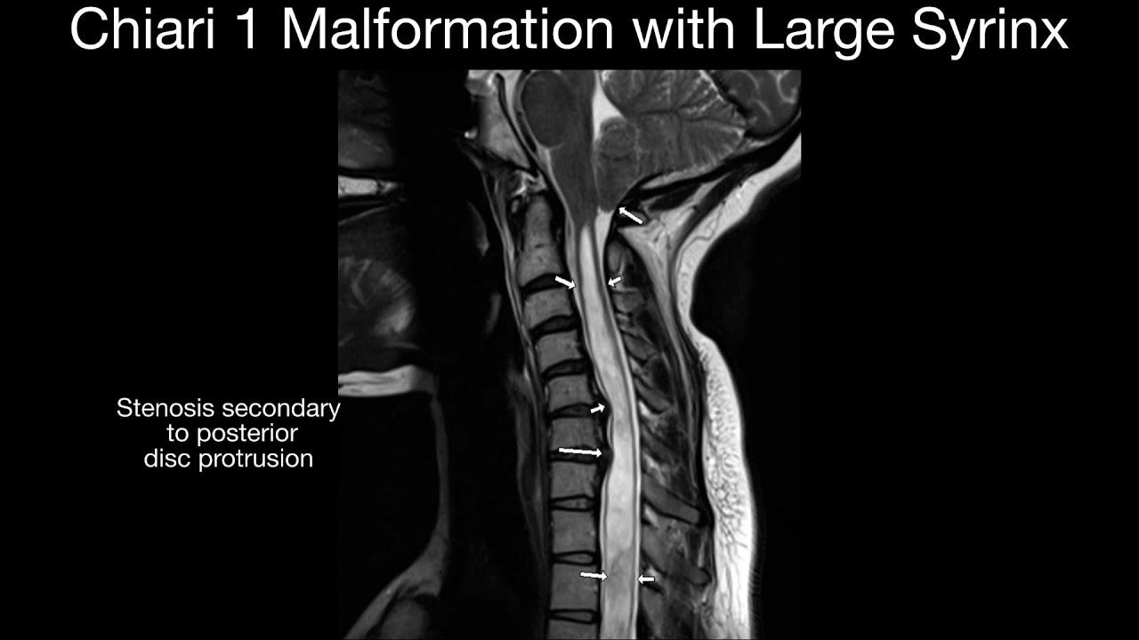 Chiari 1 Malformation with Large Syrinx - YouTube