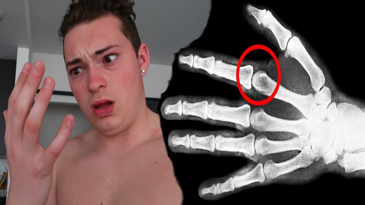 THIS IS WHAT HAPPENS WHEN YOU CRACK YOUR KNUCKLES YouTube