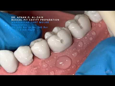 Class II cavity preparation for amalgam - mandibular molar #36 -  Preclinical Operative - Arabic عربي 