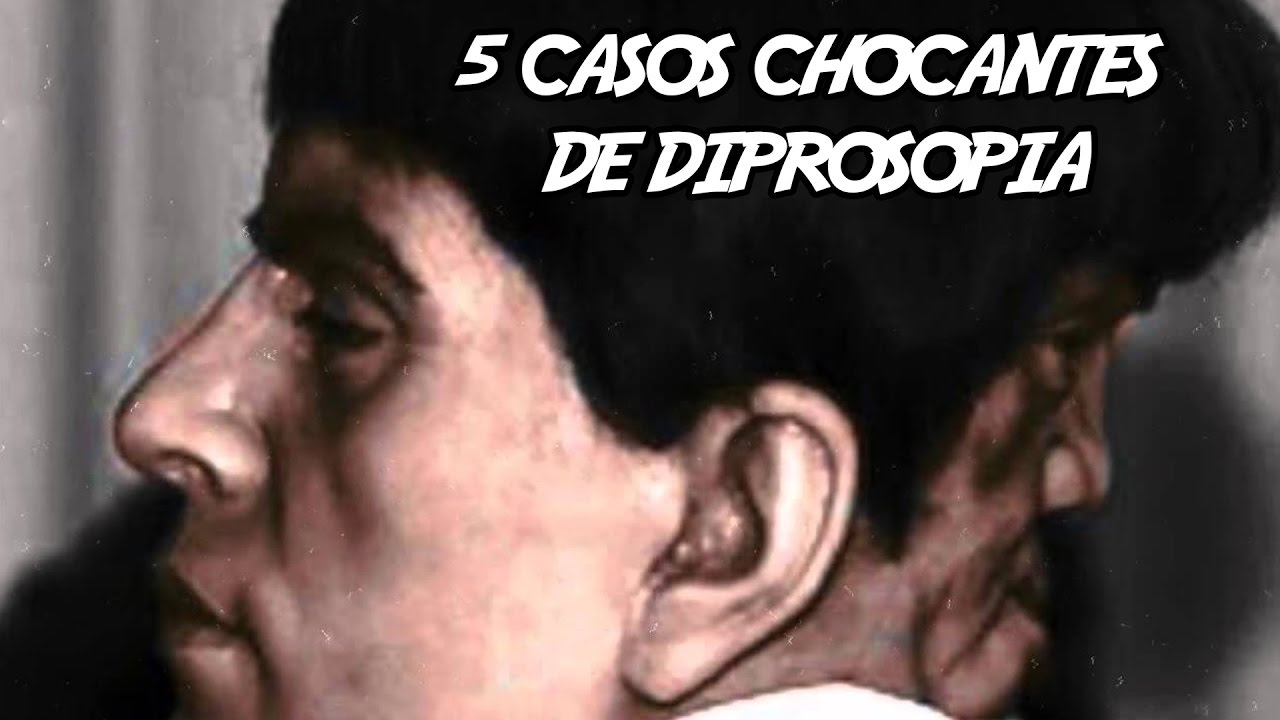 5 Casos Chocantes de Diprosopia