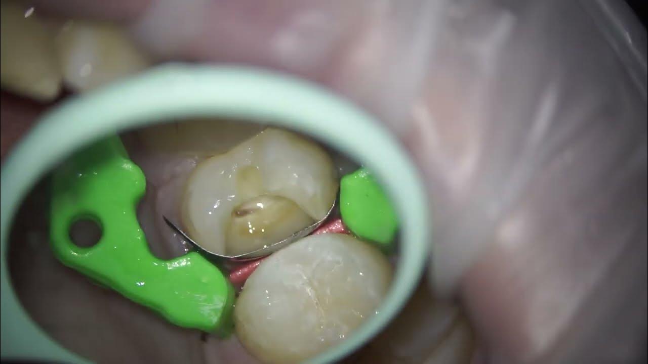 Achieve Perfect Endodontic Tooth Build Up with Expert Techniques 