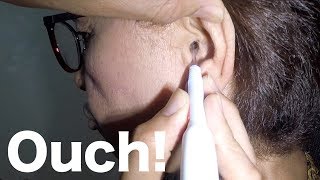 80 Year Old Woman's Earwax Removed with Caution & Care