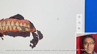 How to use Scan Body to scan Implant Crown using Medit500 3D scanner