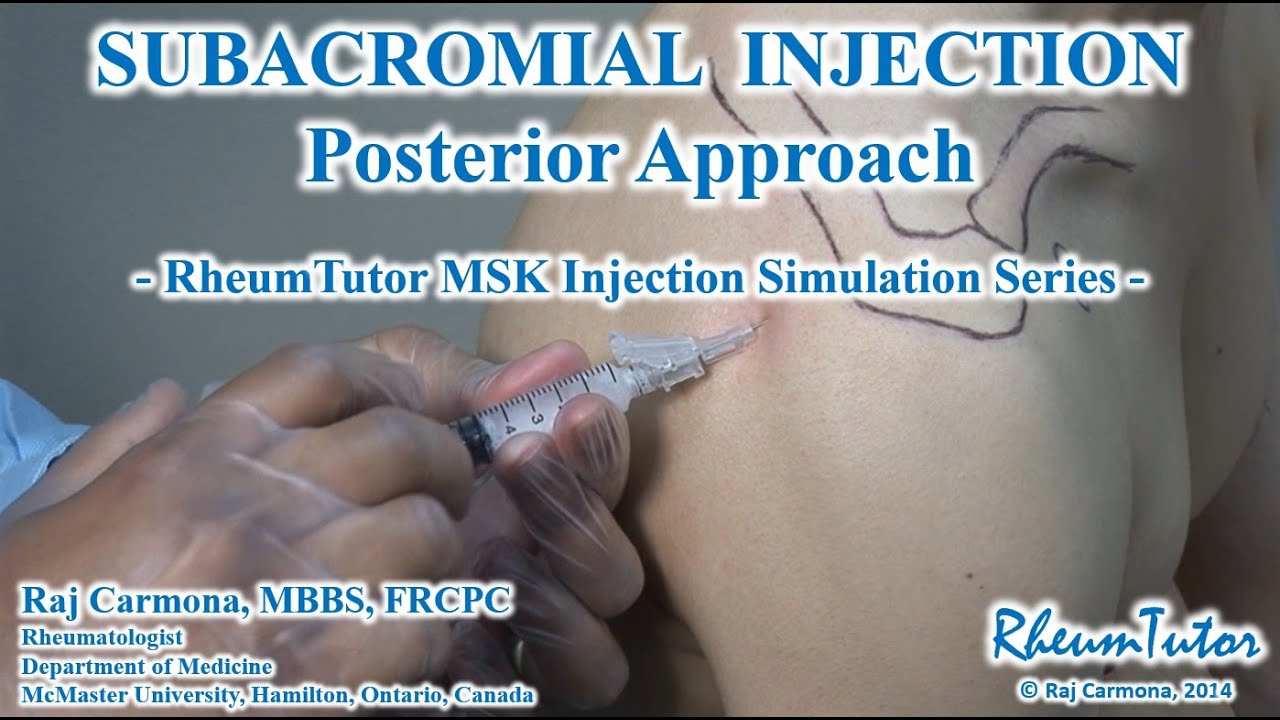 Subacromial Inj SUBACROMIAL SHOULDER INJECTION - POSTERIOR APPROACH: Step-By-Step ...