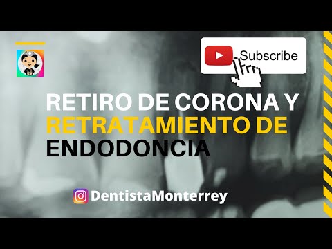 Video: ¿Se puede retirar una endodoncia?