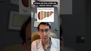 These are the stages of fatty liver #fattyliver #doctor #gastroenterology