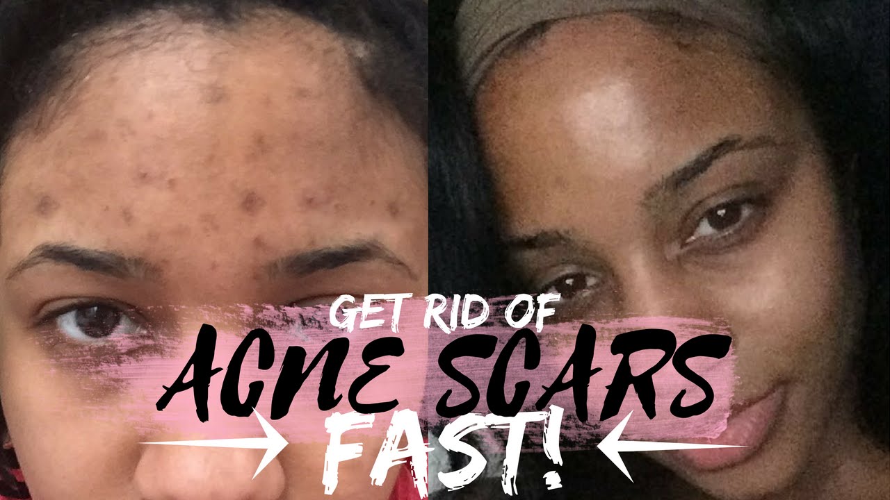 The Way To Remove Zits Scars Microneedling There Are Numerous Treatments Obtainable To Help Fade The Diverse Styles Of Acne Scarring Consisting Of Lasers And Microdermabrasion However Marshalls