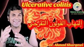 Ulcerative colitis  إلتهاب القولون التقرحي، ماهو؟ أسبابه؟ أعراضه؟ العلاج الطبي و الطبيعي