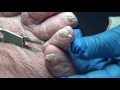Thick Fungal Nails and Wound on Diabetic Patient with Lymphedema