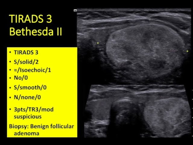 Tmt Tirads Bethesda By Dr Alka Singhal Youtube