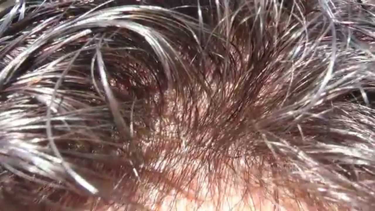 PROTESI CAPELLI NATURALI CASERTA NAPOLI - Protesi capelli veri