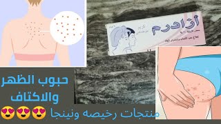 علاج حبوب الظهر والاكتاف