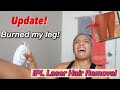 Burned My Leg with IPL Laser Hair Removal 2 MONTH UPDATE // Lux Skin