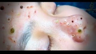 Download Lagu Huge blackhead removal from nose/ old aged blackheads removal/ cystic blackheads whiteheads removal MP3 Download Lagu Huge blackhead removal from nose/ old aged blackheads removal/ cystic blackheads whiteheads removal MP3