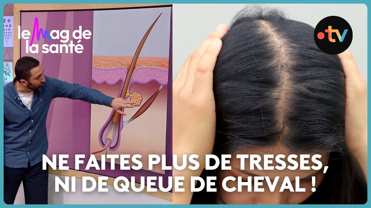 Chute de cheveux : causes, seuils d'alerte et alopécie androgénétique