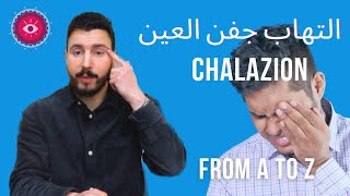 (chalazion) التهاب جفن العين .. تخلص منه الى الأبد