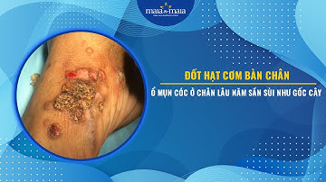 Đốt hạt cơm bàn chân - Ổ mụn cóc ở chân lâu năm sần sùi như gốc cây