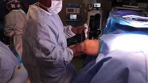 Incisionless Partial Medial Meniscectomy