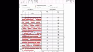 Cardiac Arrest Part 3: How to interpret your Code Stat report