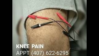 Dry Needling Acupuncture with Electrical Stimulation for Knee Pain I Orlando Area Chiropractor