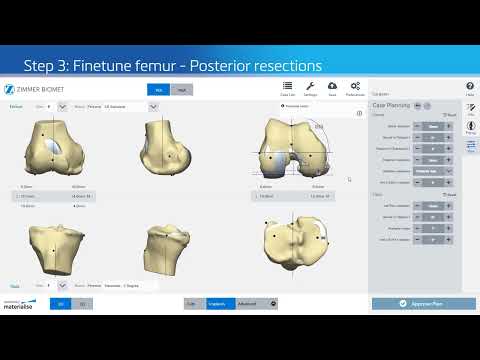 Tutorial How to Personalize Knee Alignment with 3D Planning and Guides