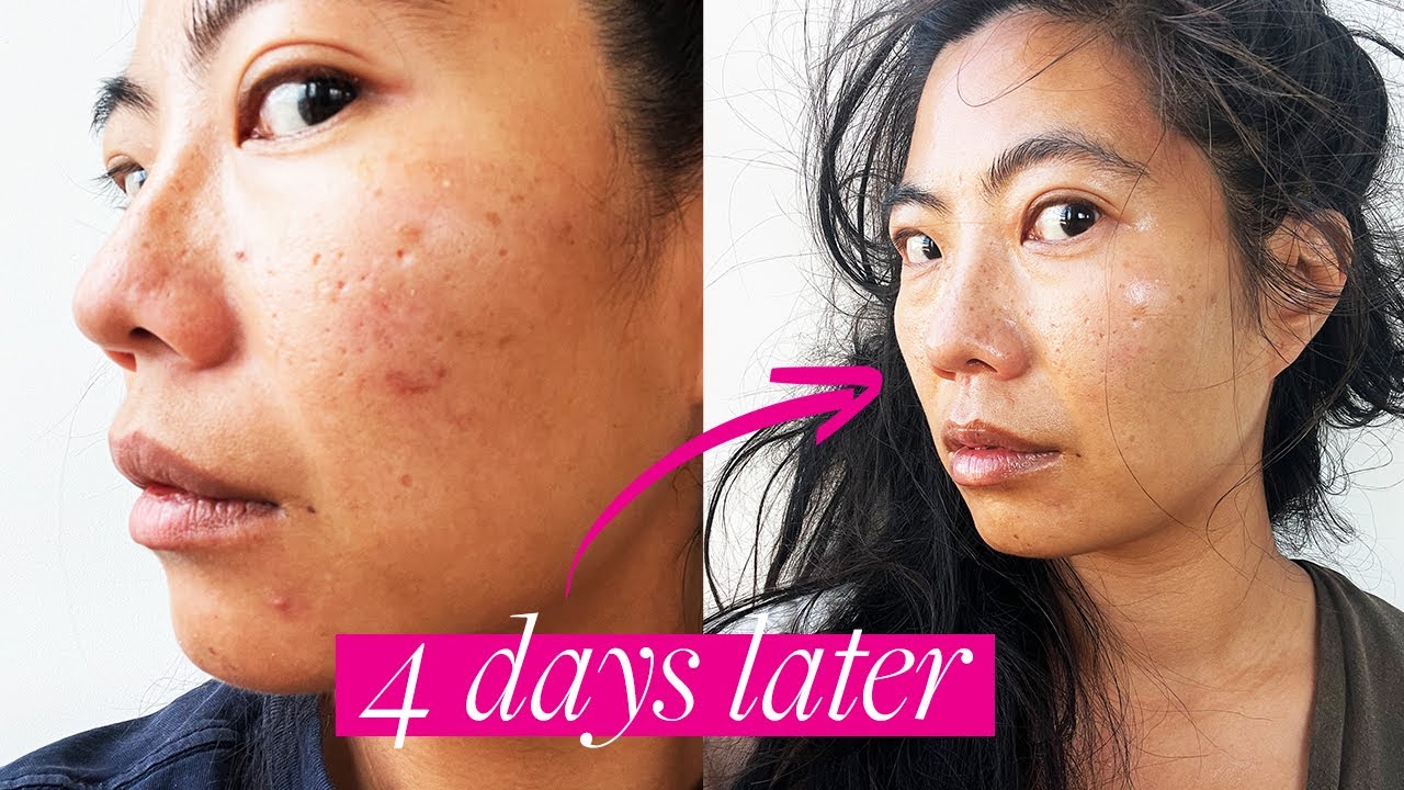 I Fixed My BAD Skin Barrier in 4 DAYS and You Can TOO! - YouTube