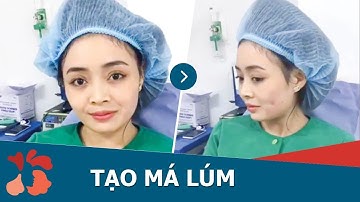 Tạo má lúm đồng tiền công nghệ Hàn Quốc không phẫu thuật