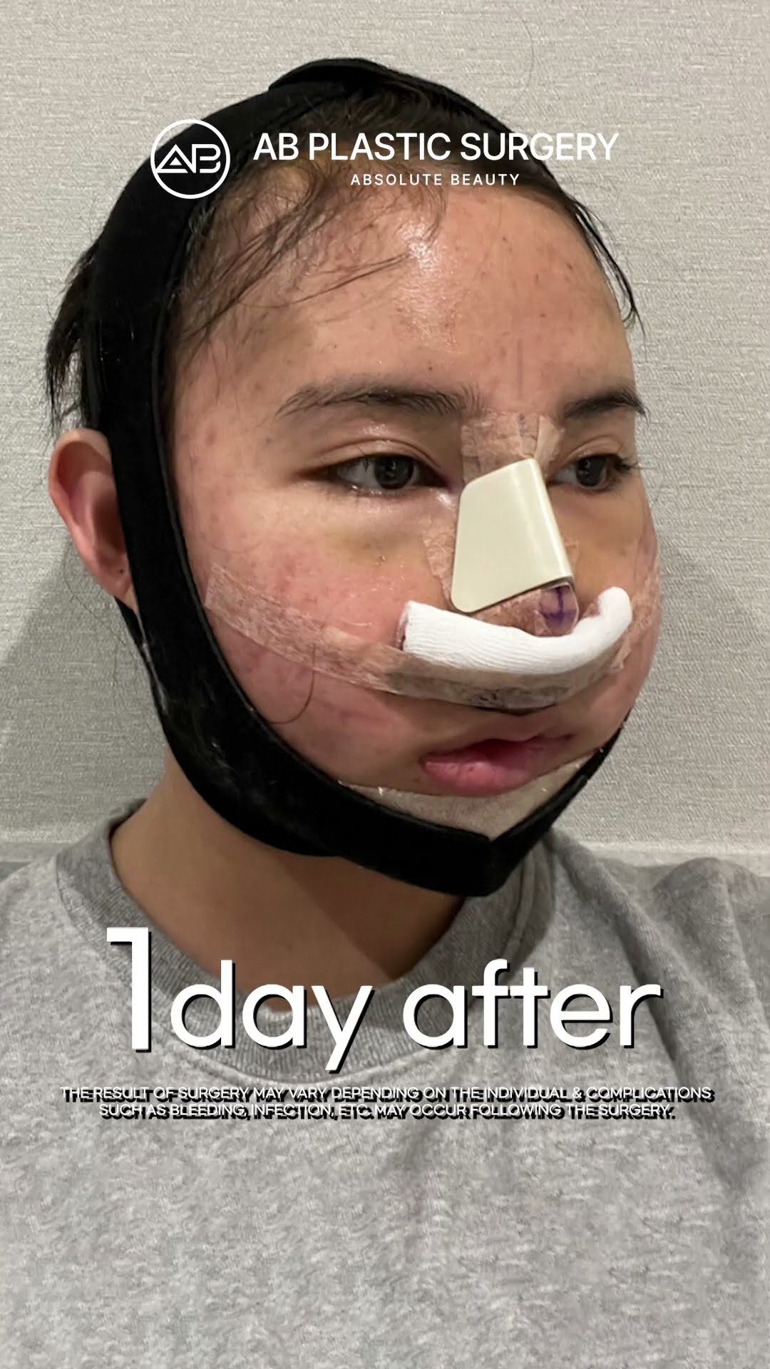 [Plastic Surgery in Korea] Facial Contouring 3-set + Wide Nose + Short Nose Surgery