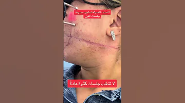 ازالة الندبات بالليزر فركشينال ليزر CO2 